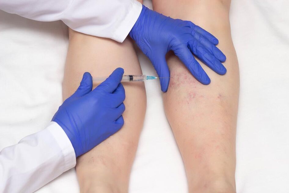 Die Sklerotherapie ist eine Methode zur Behandlung von Krampfadern.