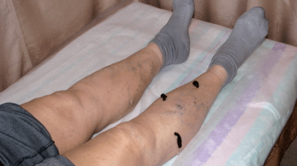 Behandlung von Krampfadern mit Blutegeln