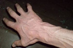 Methoden zur Behandlung von Krampfadern an den Händen