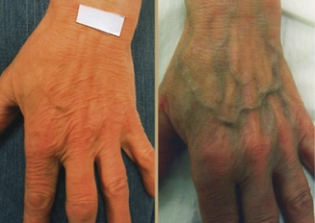 Ursachen von Krampfadern in den Händen