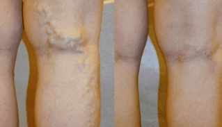 Anzeichen und Symptome von Krampfadern in den Beinen bei Männern