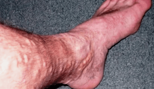 Ursachen von Krampfadern in den Beinen bei Männern