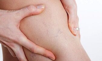 Gründe für die Entstehung von Krampfadern in den Beinen.