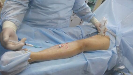 Operation bei Krampfadern in den Beinen. 