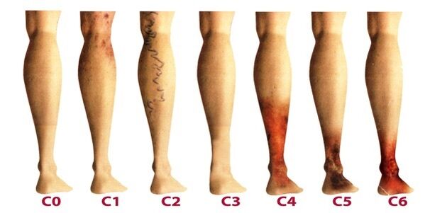 Entwicklungsstadien von Krampfadern in den Beinen
