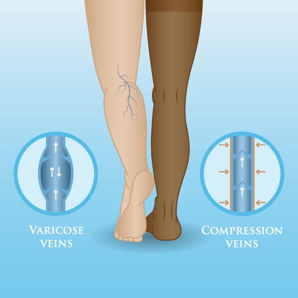 Auswirkungen von Kompressionswäsche auf Krampfadern der Beine