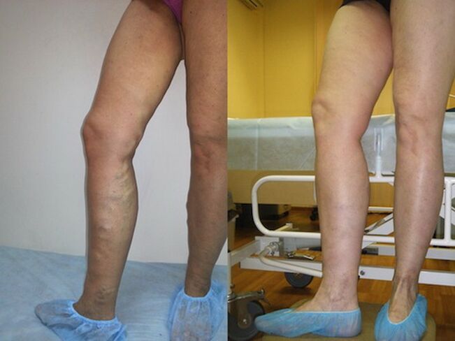 Beine vor und nach der Krampfader-Laserbehandlung