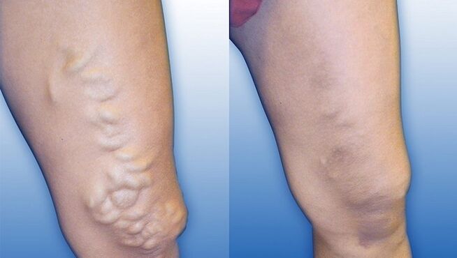 Beine vor und nach schwerer Krampfaderbehandlung