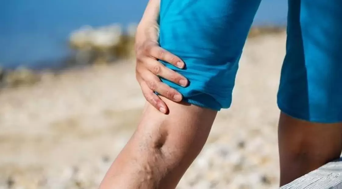 Hervortretende blaue Venen an den Beinen sind ein Zeichen für Krampfadern. 